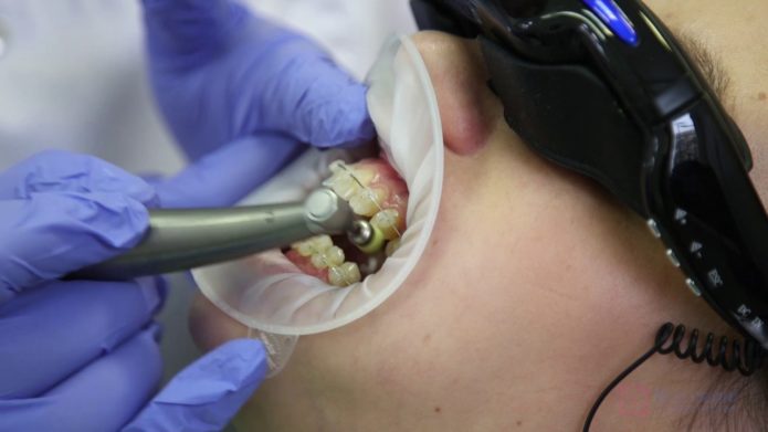 Spazzolatura dei denti