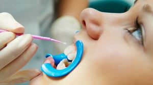 Caratteristiche dell'argentatura dei denti da latte nei bambini