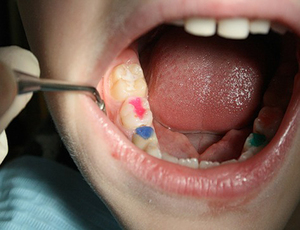 Vantaggi e svantaggi dell'argentatura e lucidatura dei denti per i bambini
