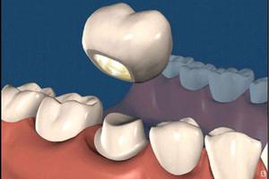Corone di denti
