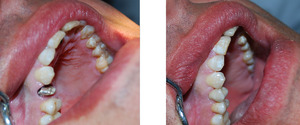 Come installare la corona sul dente