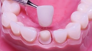 Installazione di corone sui denti