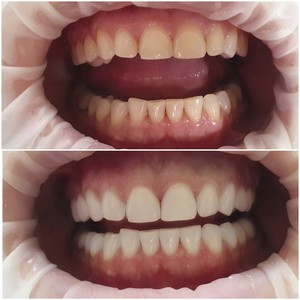 Come è la procedura di sbiancamento dei denti?
