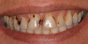 Aree di denti che sono più sensibili alla formazione di carie