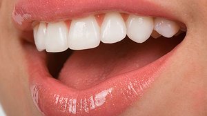 Tipi di faccette dentali