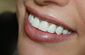 Installazione di faccette sui denti