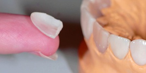Come installare faccette sui denti