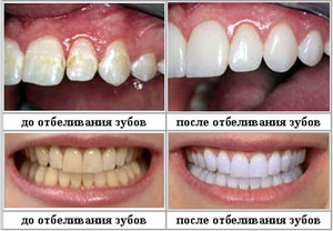 Dopo lo sbiancamento dei denti