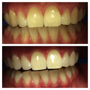 Quale metodo di sbiancamento dei denti dà i migliori risultati