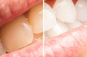 Come sbiancare i denti