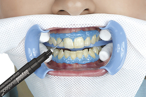 Metodi di sbiancamento dei denti popolari