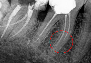Fa male un dente dopo il riempimento
