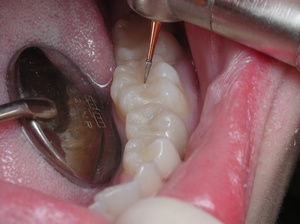 Quali sono le otturazioni sui denti