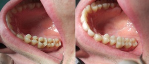 Riempimento dentale nello studio dentistico
