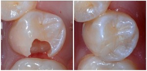 Com'è la procedura per riempire i denti