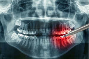 Ciò che dà un'immagine panoramica dei denti