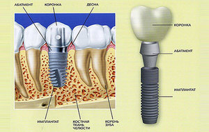 Impianti dentali
