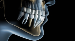 Svantaggi degli impianti dentali