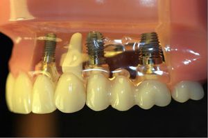 Denti Imptalny