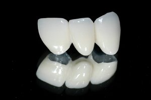 Ceramica metallo corona