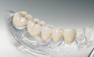 Prendersi cura di protesi in metallo-ceramica