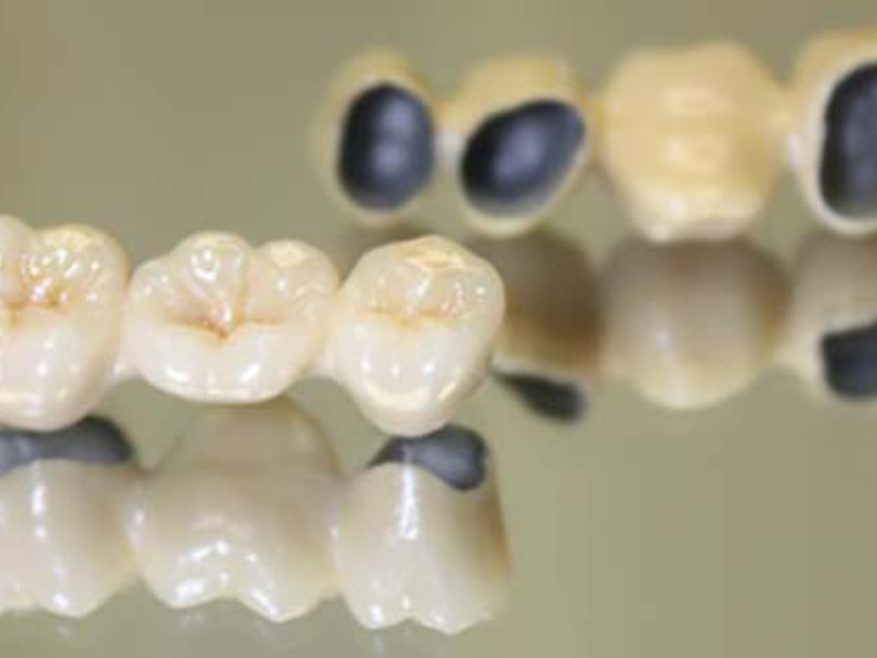 Protesi in ceramica metallica Che tipo di protesi è meglio