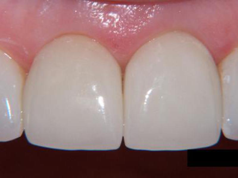 Protesi di metallo in ceramica Ceramica moderna in metallo