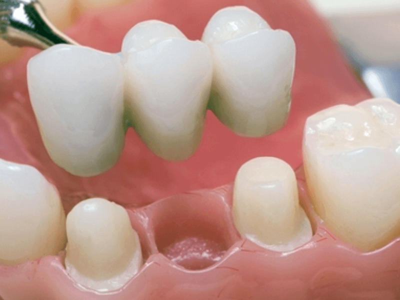 Quali sono i vantaggi del cermet Denti di cermet