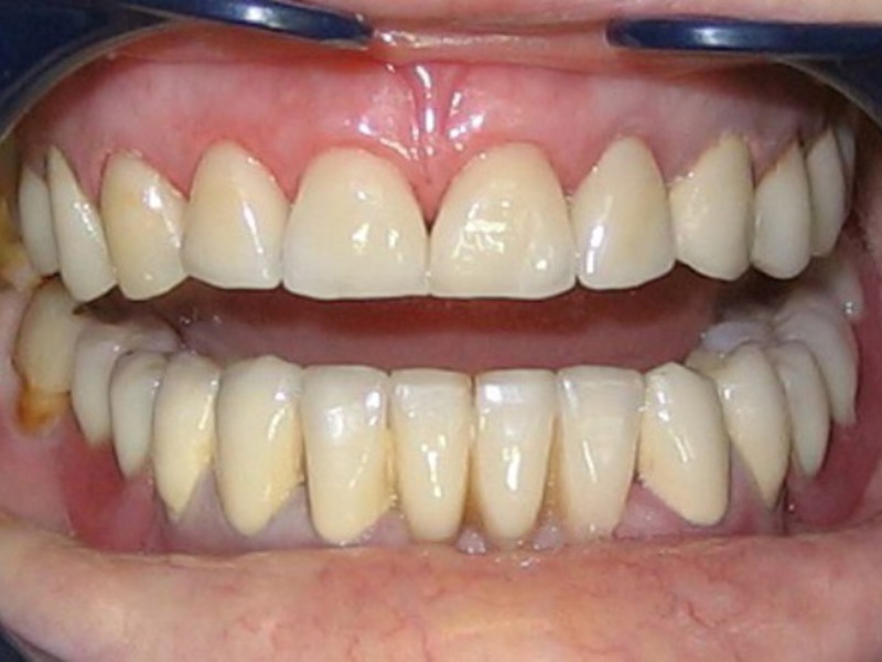 Materiali per la fabbricazione di denti Quali protesi sono meglio