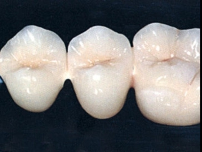 Caratteristiche della ceramica metallica Protesi parziale o totale