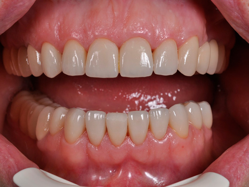 Protesi di metallo in ceramica Quali sono i vantaggi del cermet