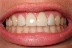 Denti umani che costituiscono la dentatura
