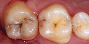 Descrizione dei denti da masticare e delle zanne umane