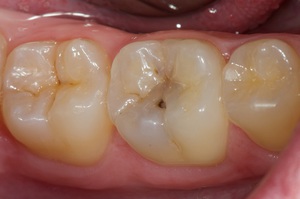 Descrizione dei denti dei molari umani