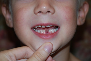 La struttura e le caratteristiche dei denti da latte