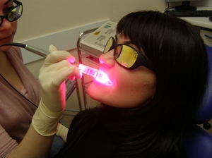  Lo sbiancamento laser dei denti viene eseguito in cliniche dentali e cosmetiche.