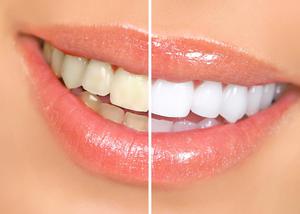 Sbiancamento dei denti: come cambia il tuo sorriso