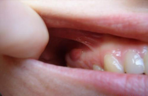 Cause della formazione di cisti dentali