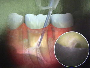 Anestesia per curette per tasche parodontali