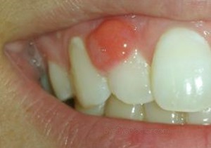 Cause dell'ascesso dentale