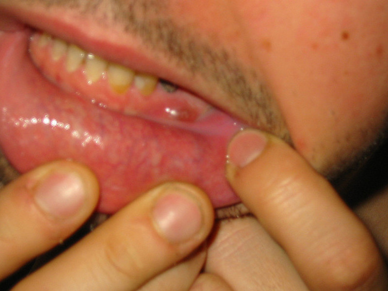 Cause dell'ascesso dentale Ascesso dentale