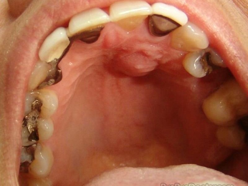 Cos'è un ascesso Cause dell'ascesso dentale
