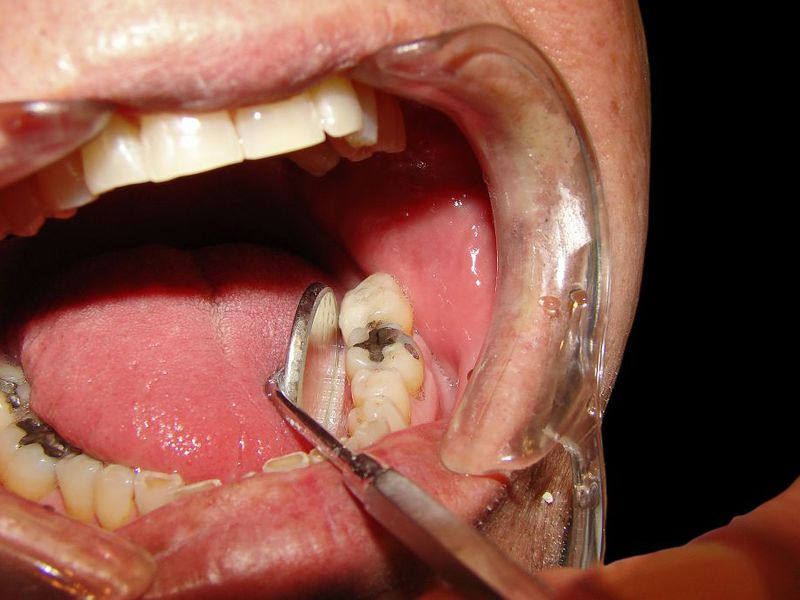 Ascesso sulla mascella inferiore Come trattare l'ascesso dentale