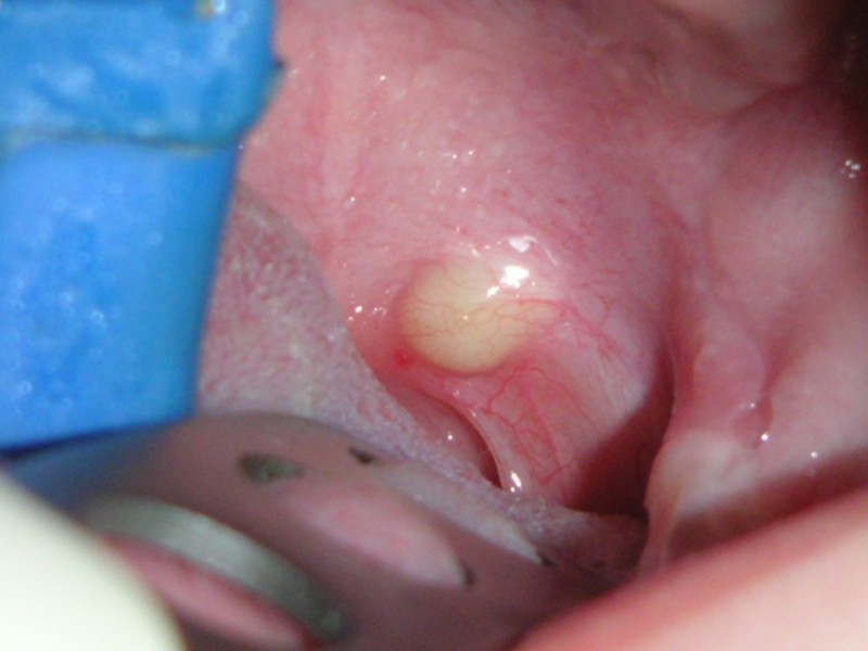 Come trattare l'ascesso dentale Sintomi di ascesso dentale