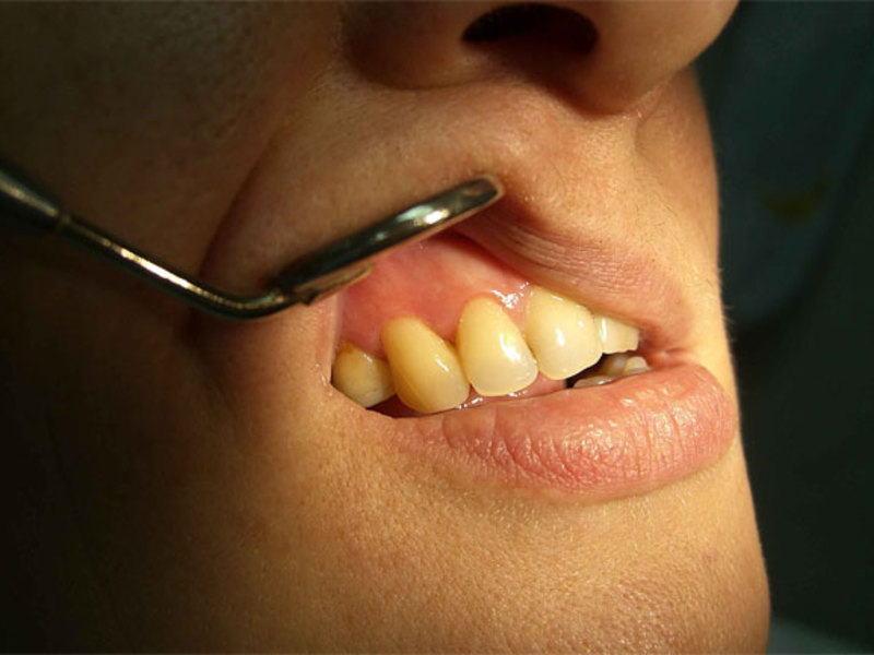 Medicinali per il trattamento dei denti ascessi Ascesso in bocca