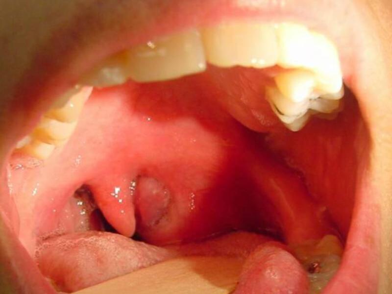 Come prevenire i denti ascessi Cause dell'ascesso dentale