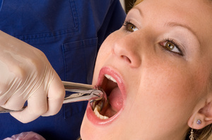 Guancia gonfia dopo l'estrazione del dente