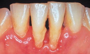 Controindicazioni all'uso di protesi in nylon