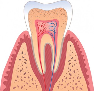 Rimozione del nervo nel dente