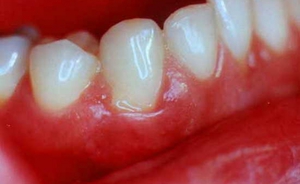 Il prezzo della colla dentale adesiva Solcoseryl